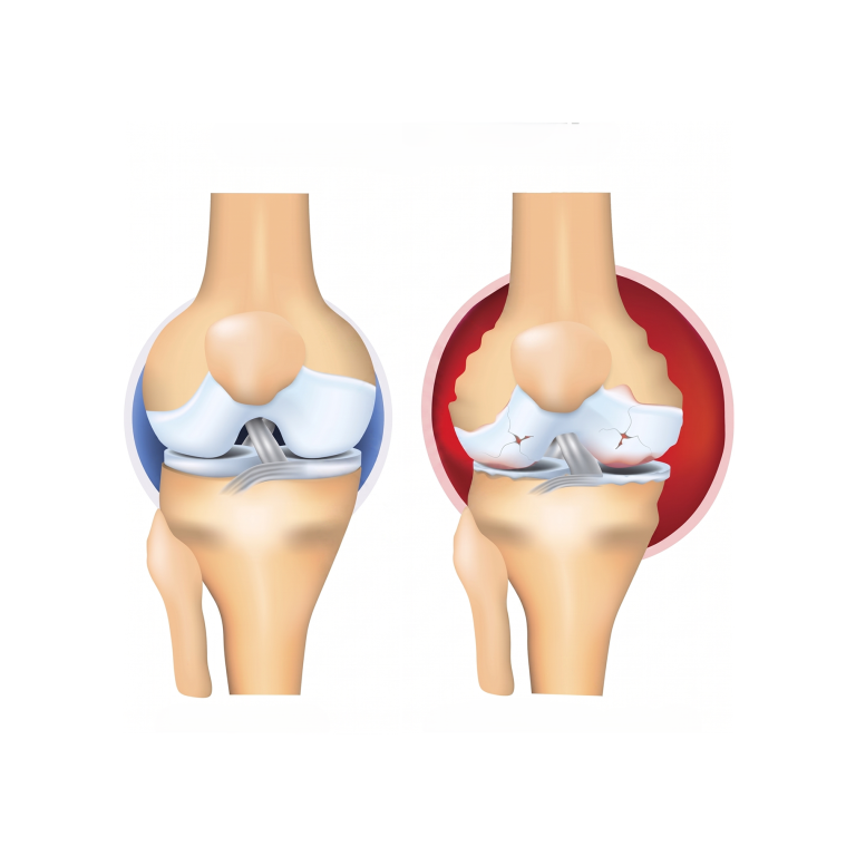 Arthritis 1